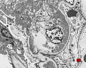 M,19y. | membranous glomerulopathy - lupus erythematodes st. IV M,19y. | membranous glomerulopathy - lupus erythematodes st. IV